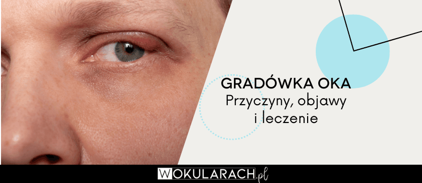 Co to jest gradówka oka? Przyczyny, objawy i leczenie | wOkularach.pl