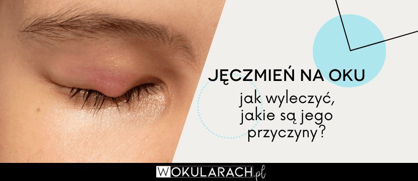 j-czmie-na-oku-jak-wyleczy-jakie-s-jego-przyczyny-wokularach-pl